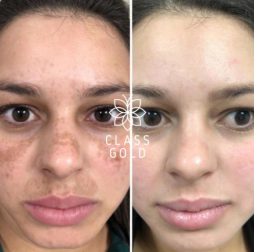 TONICO ACLARANTE FACIAL 25 ML - CLASS GOLD - Imagen 4