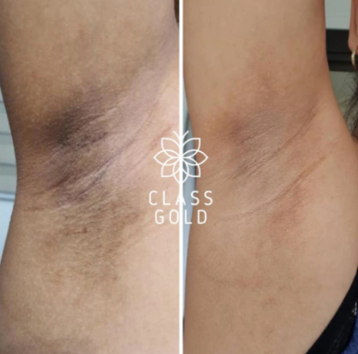 CREMA DERMOACLARANTE 60 ML - CLASS GOLD - Imagen 7
